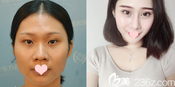 南寧東方整形醫(yī)院劉剛雙眼皮案例 南寧東方整形醫(yī)院劉剛雙眼皮案例