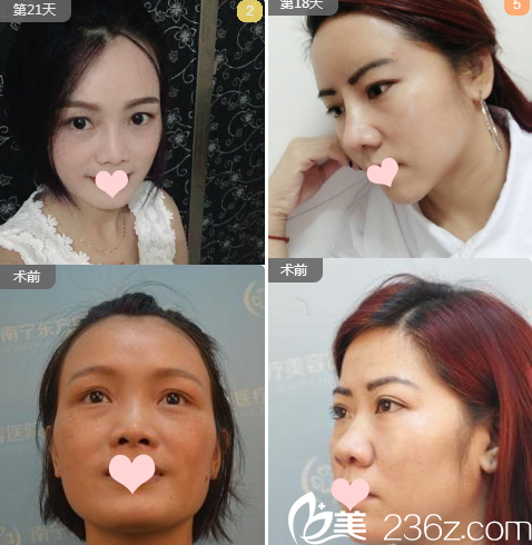 南寧東方劉剛鼻綜合案例對(duì)比組圖 南寧東方劉剛鼻綜合案例對(duì)比組圖