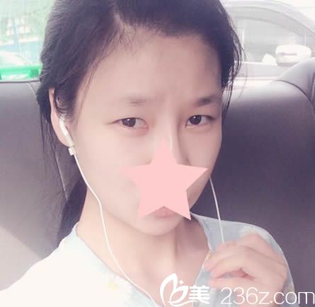 做雙眼皮前的樣子 做雙眼皮前的樣子