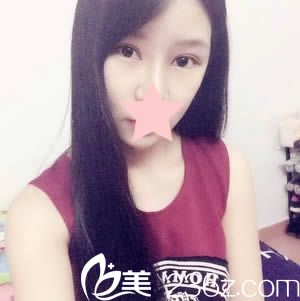 大家來看石獅栢麗整形醫(yī)院盛宗順為我做的雙眼皮好不好？