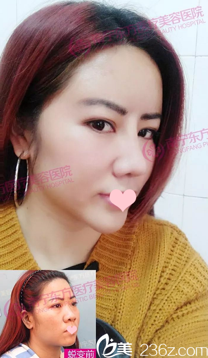 找南寧東方劉剛院長做完隆鼻半個月對比照