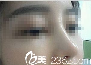 進(jìn)行鼻修復(fù)手術(shù)后的鼻子