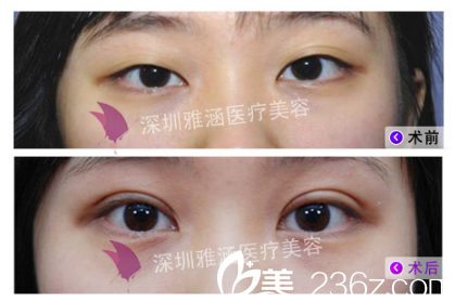 侯文明做眼睛怎么樣？看雙眼皮案例對(duì)比圖