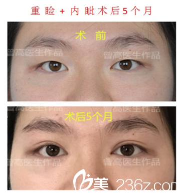 廣州華美曾高做的雙眼皮案例