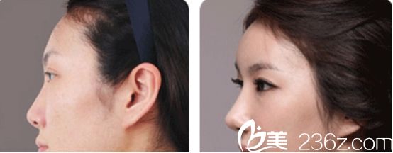 杭州愛(ài)琴海醫(yī)院隆鼻真人案例2