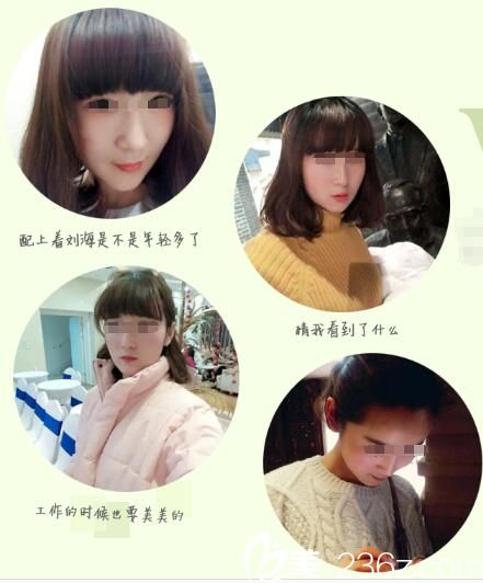 在蘇州芘麗芙華美19870元做面部脂肪填充+鼻綜合全過程