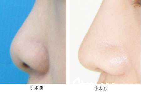 鼻部整形手術(shù)前后對(duì)比圖