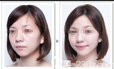 玻尿酸豐蘋(píng)果肌前后對(duì)比圖
