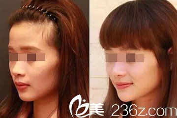 玻尿酸隆下巴---頜面整形前后對(duì)比圖