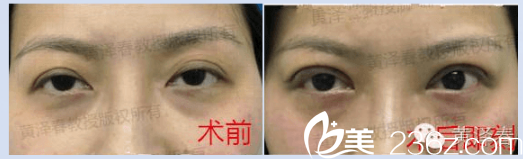 廣州美萊黃澤春雙眼皮失敗修復<span style=