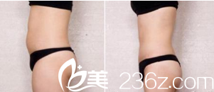 廣州美萊王志軍吸脂<span style=