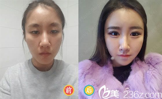 元彰焄院長的面部整形案例