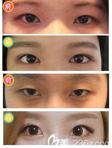 趙庸真院長的眼部整形案例 趙庸真院長的眼部整形案例