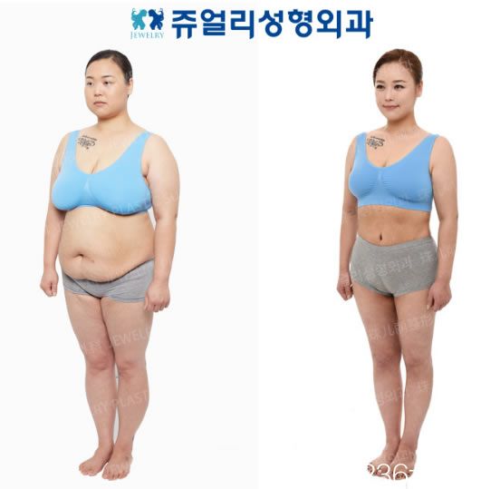 全寅成院長的肥胖管理案例 全寅成院長的肥胖管理案例