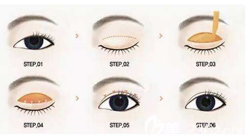 雙眼皮的手術(shù)方法