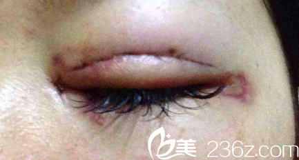 雙眼皮手術(shù)的腫脹階段