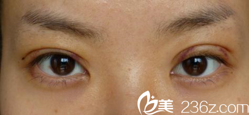 雙眼皮術(shù)后的快消階段