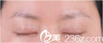 雙眼皮術(shù)后疤痕增生怎么辦