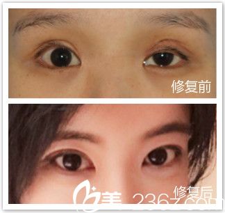 韓國清潭雙眼皮修復(fù)案例
