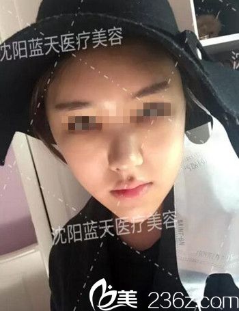 在沈陽藍天做面部脂肪填充術(shù)后3天.jpg 在沈陽藍天做面部脂肪填充術(shù)后3天.jpg