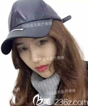 在沈陽藍天做面部脂肪填充術(shù)后2個月.jpg 在沈陽藍天做面部脂肪填充術(shù)后2個月.jpg