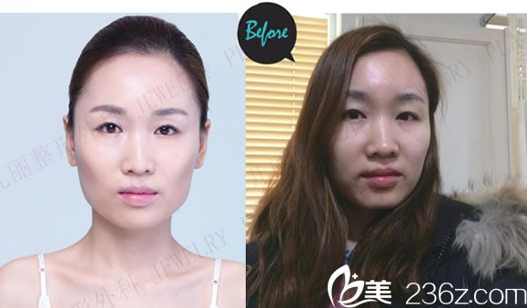 熙熙做輪廓手術(shù)前的照片 熙熙做輪廓手術(shù)前的照片