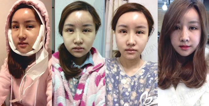 熙熙做完手術(shù)前四天的恢復(fù)圖片 熙熙做完手術(shù)前四天的恢復(fù)圖片