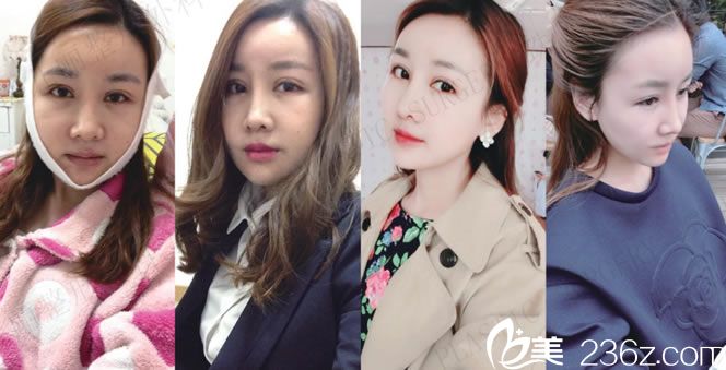 做完輪廓手術(shù)1到6周的恢復(fù)圖 做完輪廓手術(shù)1到6周的恢復(fù)圖