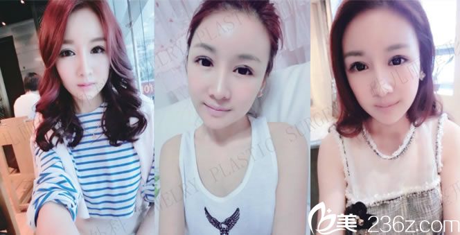 珠兒麗做完面部輪廓3月效果圖 珠兒麗做完面部輪廓3月效果圖