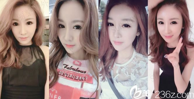 熙熙做輪廓手術(shù)變小臉的照片 熙熙做輪廓手術(shù)變小臉的照片