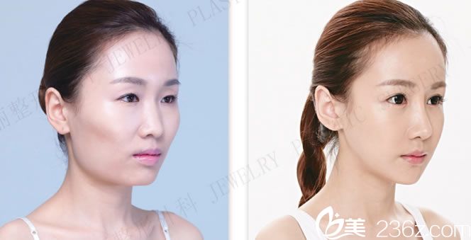 珠兒麗面部輪廓整形手術(shù)前后對比 珠兒麗面部輪廓整形手術(shù)前后對比
