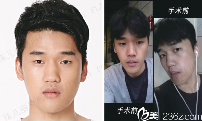 做手術(shù)前的照片