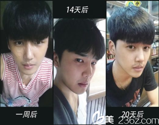 隆鼻手術(shù)前3周的效果圖