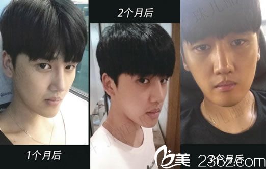 隆鼻手術(shù)3個(gè)月的效果怎么樣