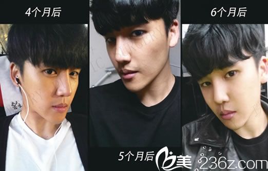 男士隆鼻手術(shù)第6個(gè)月恢復(fù)圖