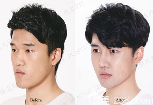 隆鼻手術(shù)前后效果對(duì)比照片