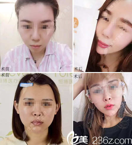 李烈面部脂肪填充案例對(duì)比照