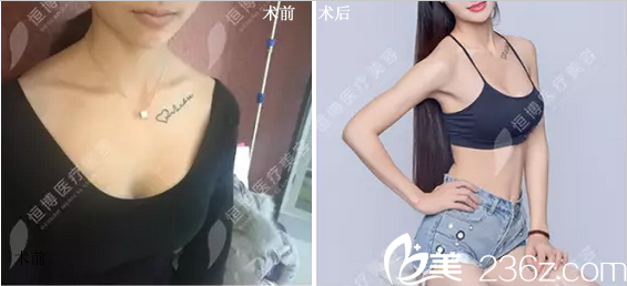 李烈自體脂肪豐胸前后對(duì)比