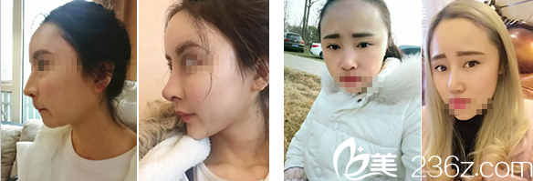 蔣代為鼻整形案例對(duì)比圖 蔣代為鼻整形案例對(duì)比圖