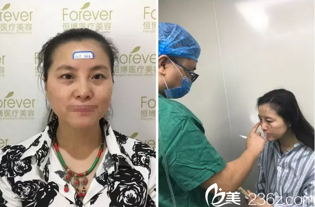 李烈自體脂肪面部填充術前設計 李烈自體脂肪面部填充術前設計