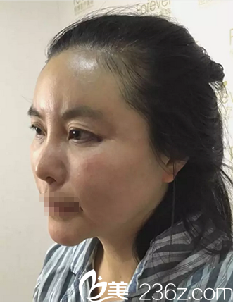 成都恒博李烈自體脂肪填充面部術后即刻效果 成都恒博李烈自體脂肪填充面部術后即刻效果