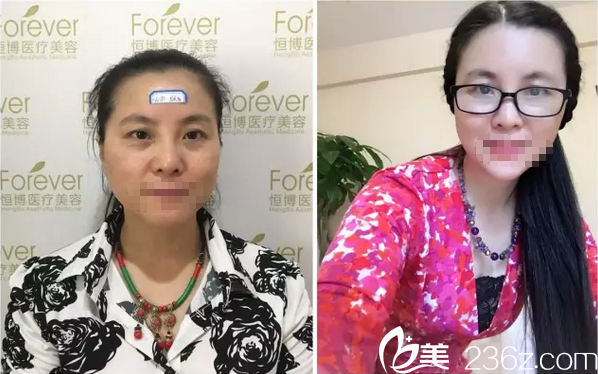 李烈面部脂肪填充術前術后對比圖 李烈面部脂肪填充術前術后對比圖