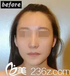 埋線提升前面部松弛無(wú)光澤