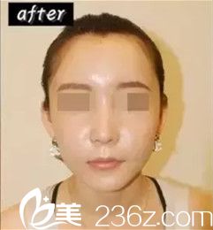 埋線提升后面部皮膚緊致有光澤