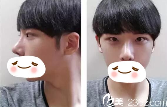 術(shù)后兩周恢復(fù)情況