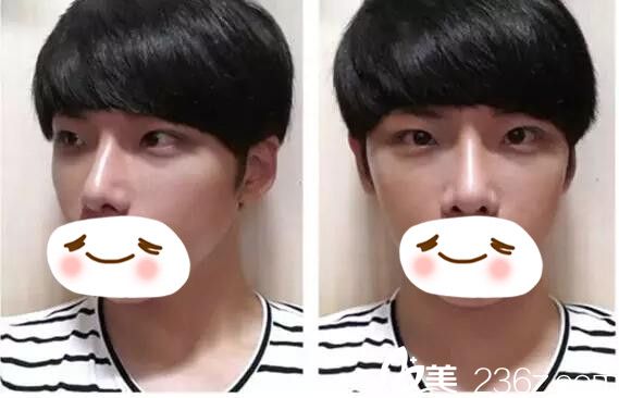 術(shù)后一個月恢復(fù)情況