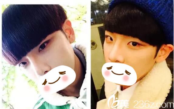 術(shù)后三個月恢復(fù)情況