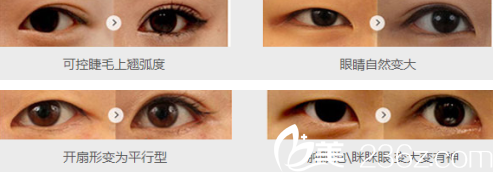 達(dá)州雙均整形美容醫(yī)院李雙均醫(yī)生做雙眼皮的手術(shù)過(guò)程 達(dá)州雙均整形美容醫(yī)院李雙均醫(yī)生做雙眼皮的手術(shù)過(guò)程