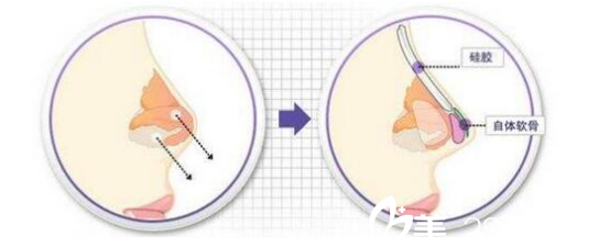 四川達(dá)州雙均整形美容醫(yī)院劉隆才醫(yī)生隆鼻流程