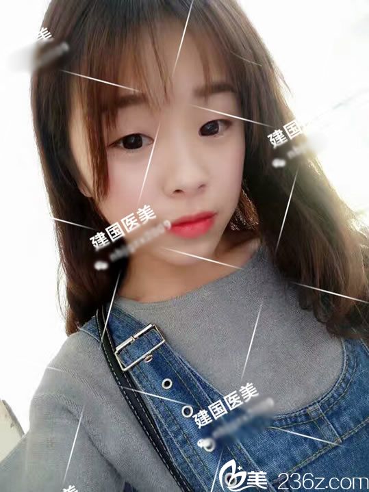 木木做雙眼皮手術(shù)前的照片 木木做雙眼皮手術(shù)前的照片